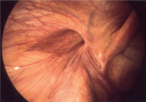 Intervento Ernia inguinale in laparoscopia - Testimonianza diretta